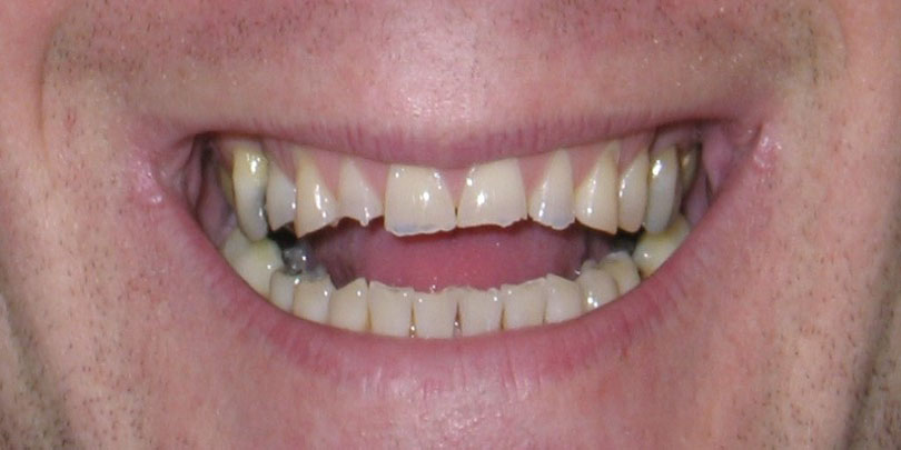 images/smile-makeover/bruxist-b4.JPG