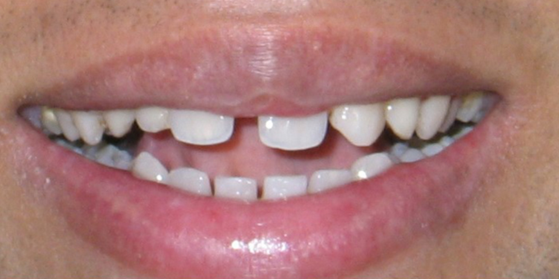 images/smile-makeover/large-central-gap-abnormal-lateral-shape-b4.jpg